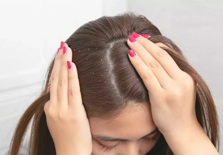 seborrheic dermatitis cream for scalp